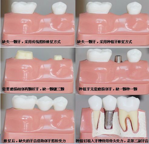 種植牙和傳統(tǒng)假牙哪個(gè)更好？