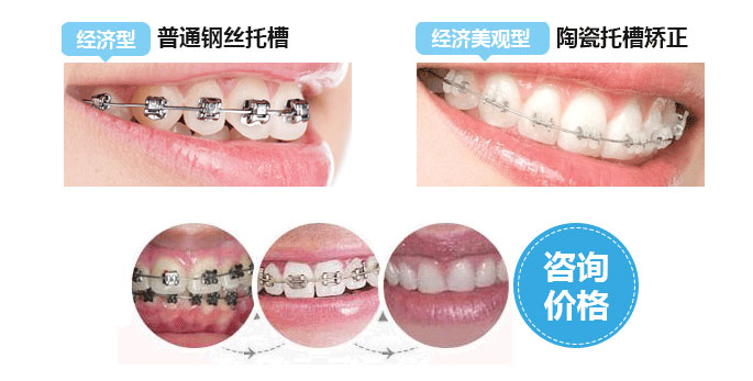 門牙有縫，擔(dān)心矯正過程不美觀，怎么辦？