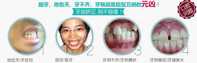 為什么說矯正牙齒要拔牙