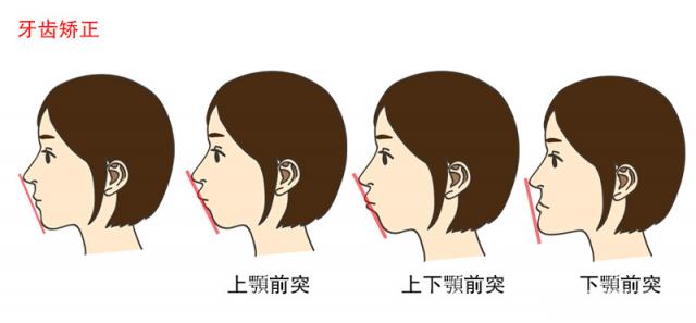 隱形矯正的過程