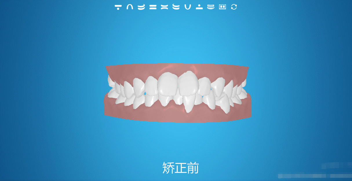 隱形矯正的過程