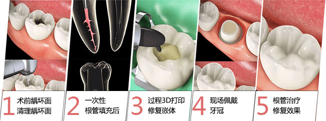 根管治療的步驟