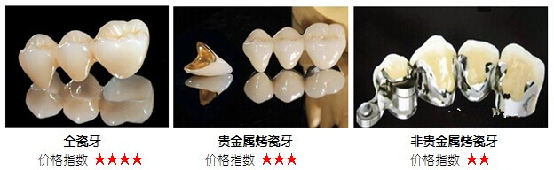 全瓷牙的優(yōu)缺點(diǎn)全瓷牙的優(yōu)缺點(diǎn)
