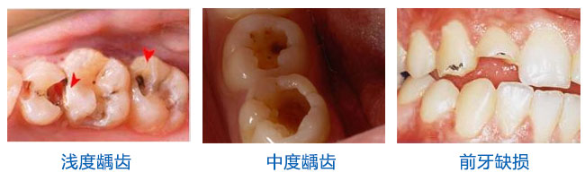 怎么確定蛀牙爛到了牙神經(jīng)
