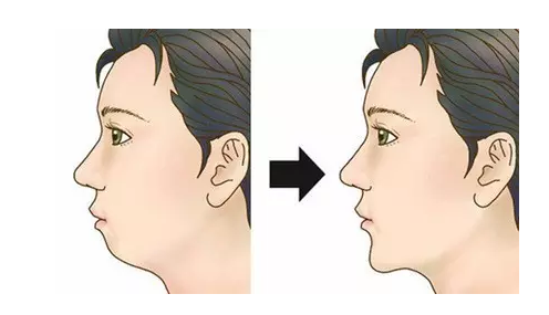 孩子牙齒矯正要多少錢