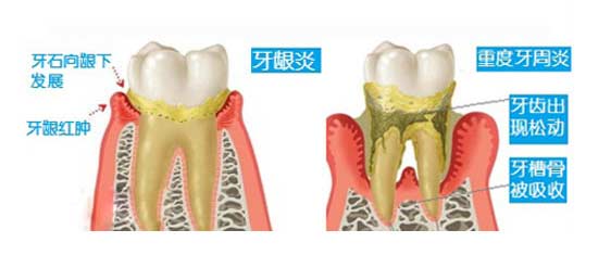 牙周炎有效的治療方法