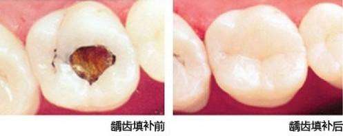 蛀牙怎么治療