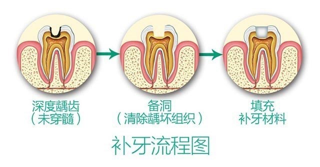 蛀牙補牙多少錢一顆