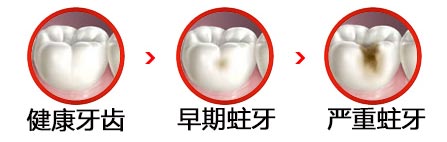 補(bǔ)一個牙洞要多少錢