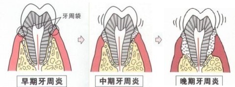 怎么樣治療牙周炎